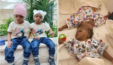 Conjoined twins separated after 19 months see each other for first time