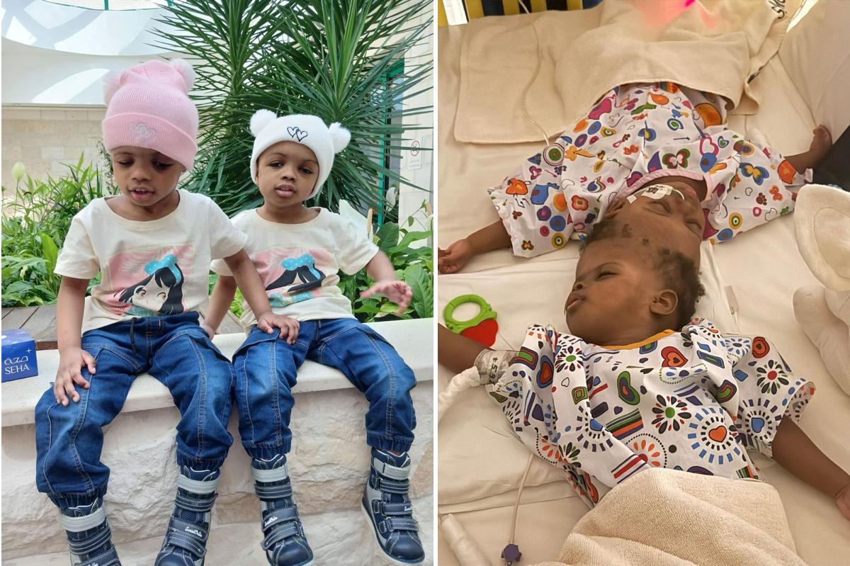 Conjoined twins separated after 19 months see each other for first time