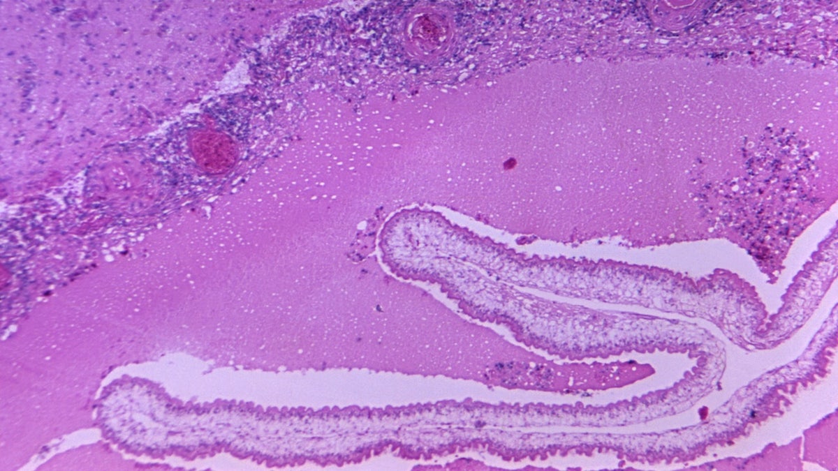 Signs of neurocysticercosis in brain scan