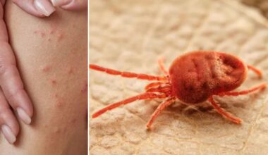 The truth about how chiggers bite skin is horrifying