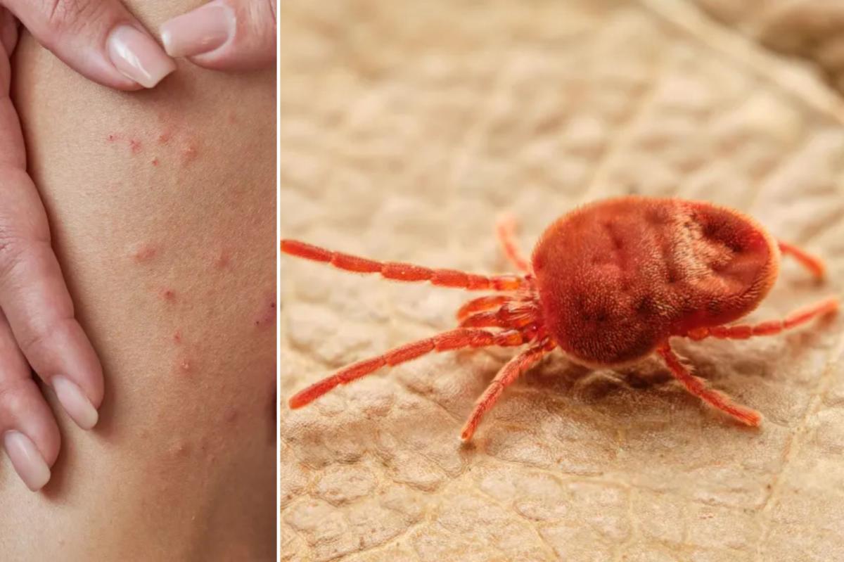 The truth about how chiggers bite skin is horrifying