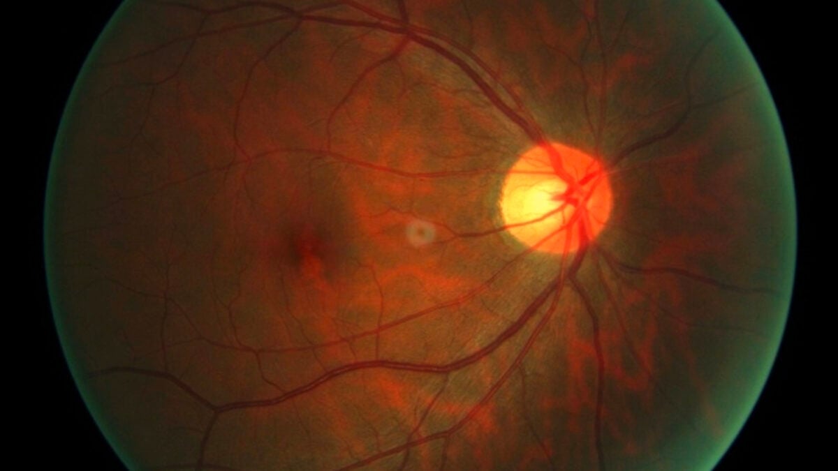 First Human Receives Experimental Therapy to Reverse Cellular Aging