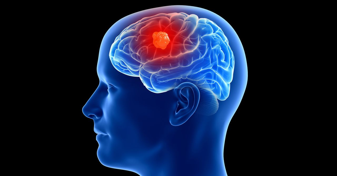 3 People Have Gotten Cancer-Detecting Implants in Their Brains