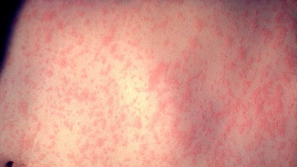 Measles in Iowa: See where you may have been exposed to measles