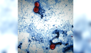 35 cases of cyclosporiasis confirmed in Connecticut: DPH – NBC Connecticut