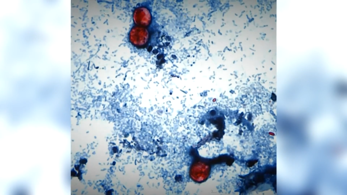 35 cases of cyclosporiasis confirmed in Connecticut: DPH – NBC Connecticut