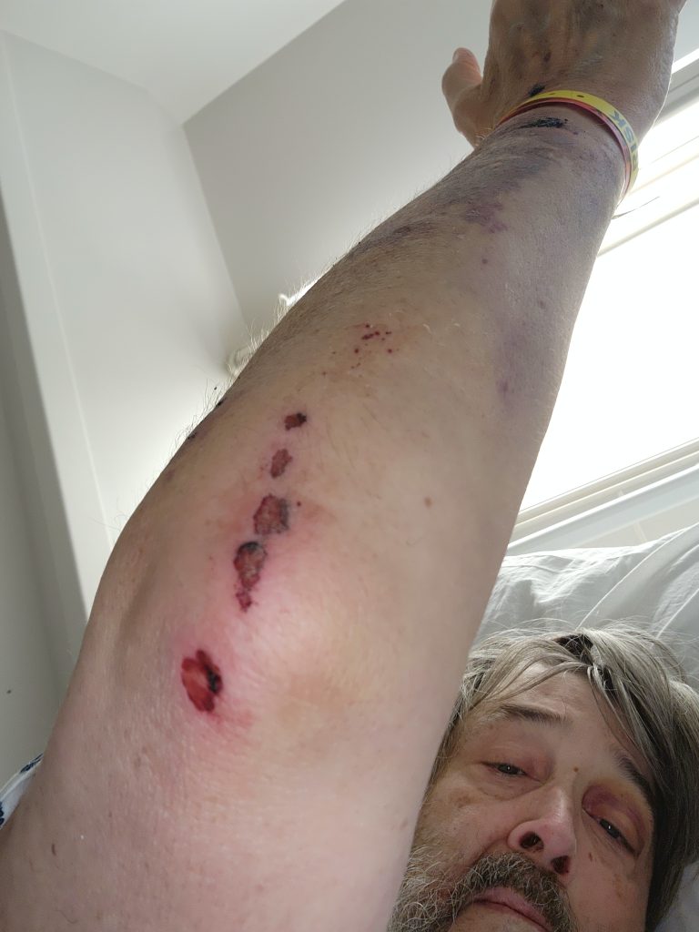 Scrapes from fall