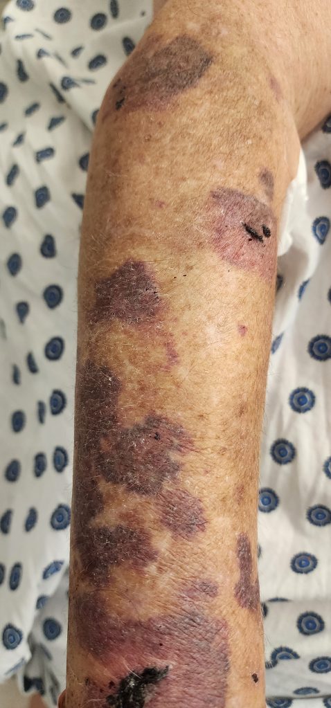 Bruises from Fall
