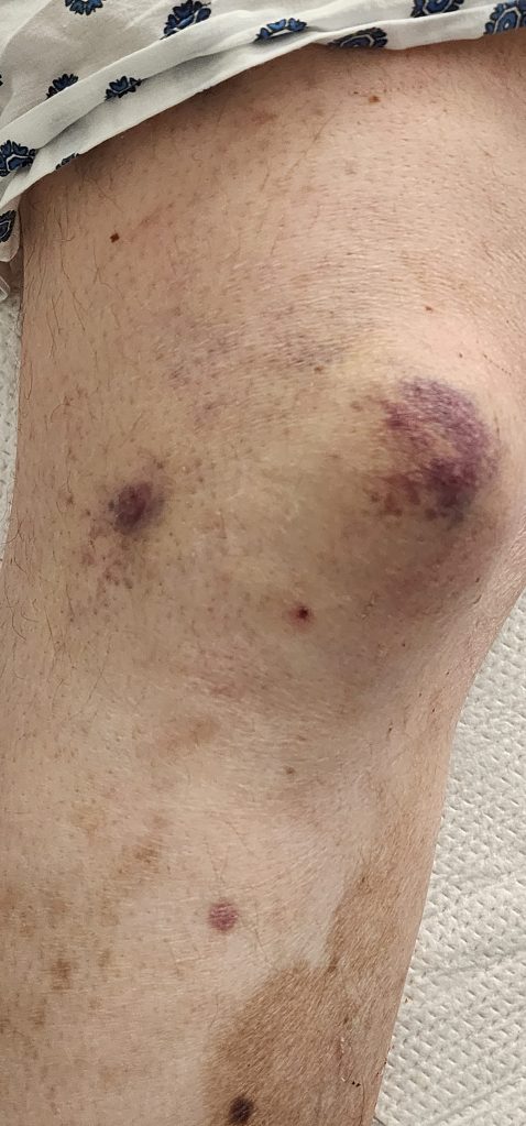 Bruises from fall