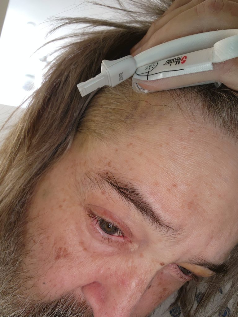 Black eye