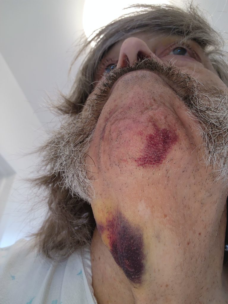 neck bruise