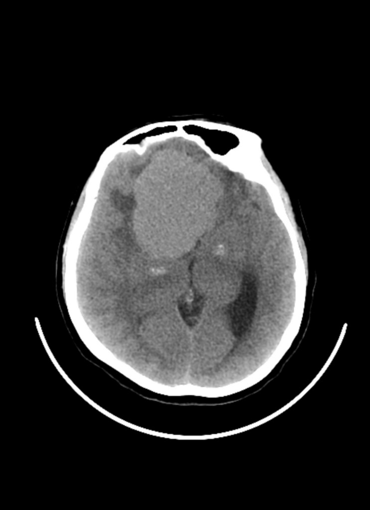 CT scan of a brain showing a large meningioma tumor.
