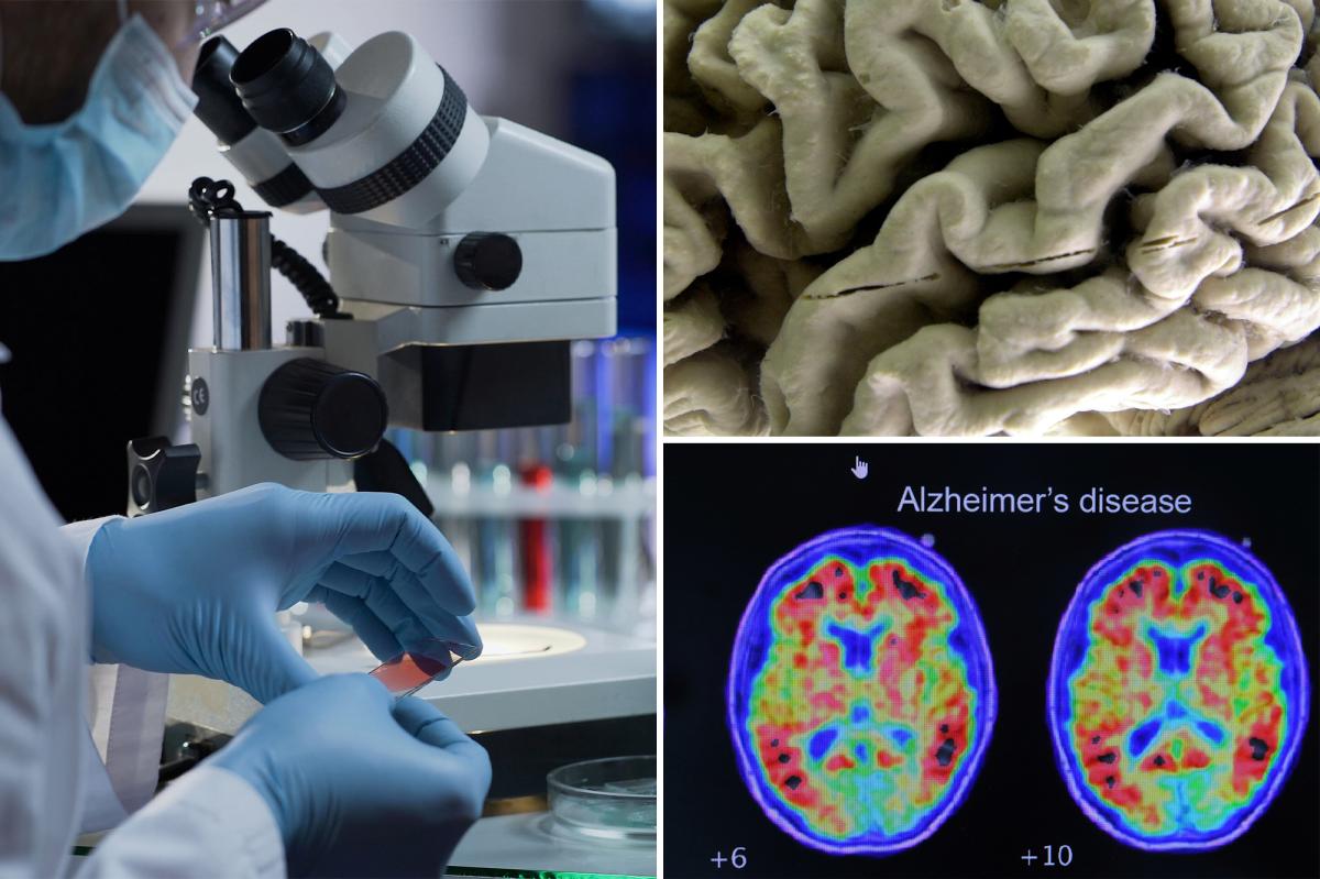 Alzheimer’s blood test may identify healthy people at high risk, study finds