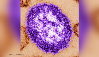 US measles cases reach 35-year high, for second record-breaking year in a row