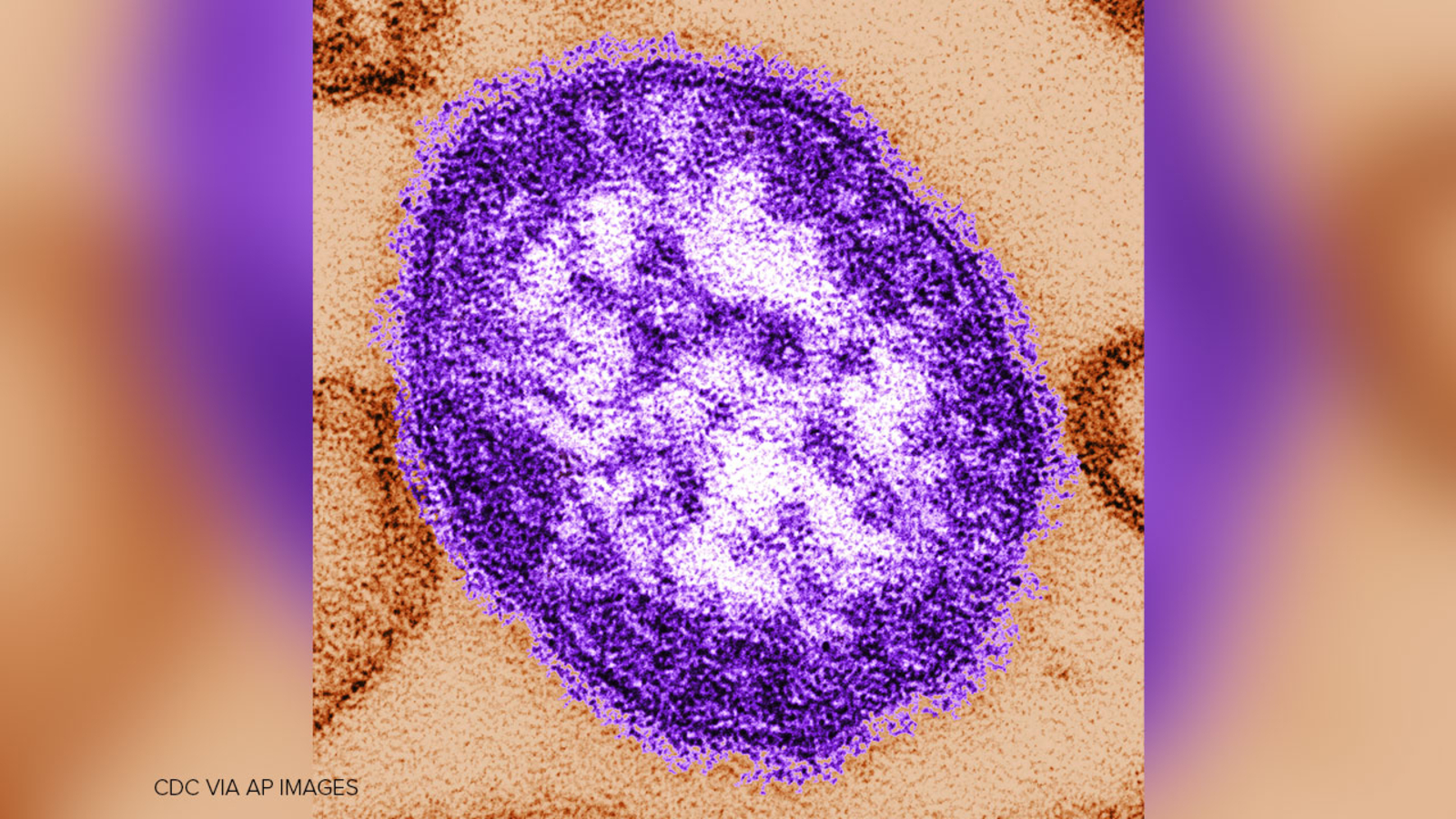 US measles cases reach 35-year high, for second record-breaking year in a row