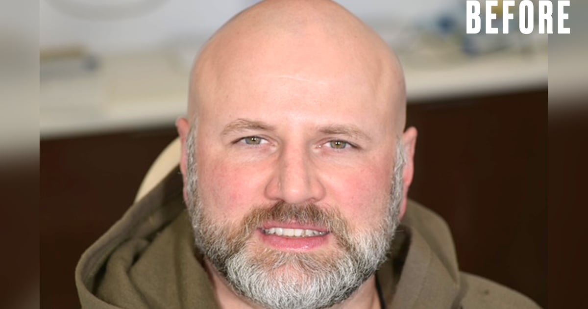 Man Gets New Smile After Years of Regret Over Veneers