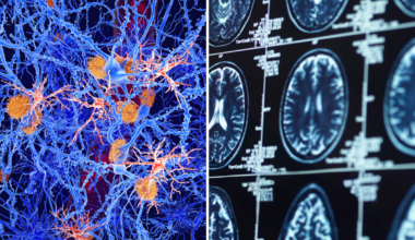 Scientists Discover How Alzheimer’s May Spread in Brain—And Way to Slow It