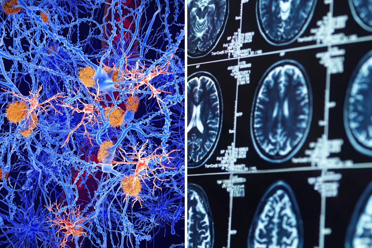 Scientists Discover How Alzheimer’s May Spread in Brain—And Way to Slow It