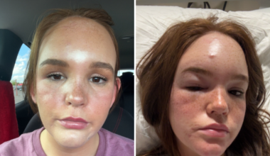 Doctors Said It Was a Spider Bite, Then She Started To Lose Her Vision