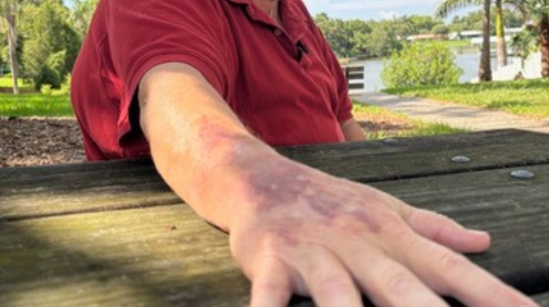Mark Armstrong's bruises come and go