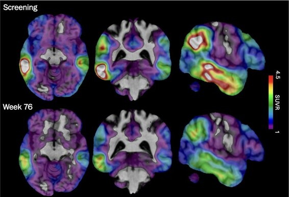 These brain scan images provided by Biogen show how high levels of Alzheimer's-related tau protein, in red, dropped in a recipient of the company's experimental drug diranersen. (Biogen via AP)