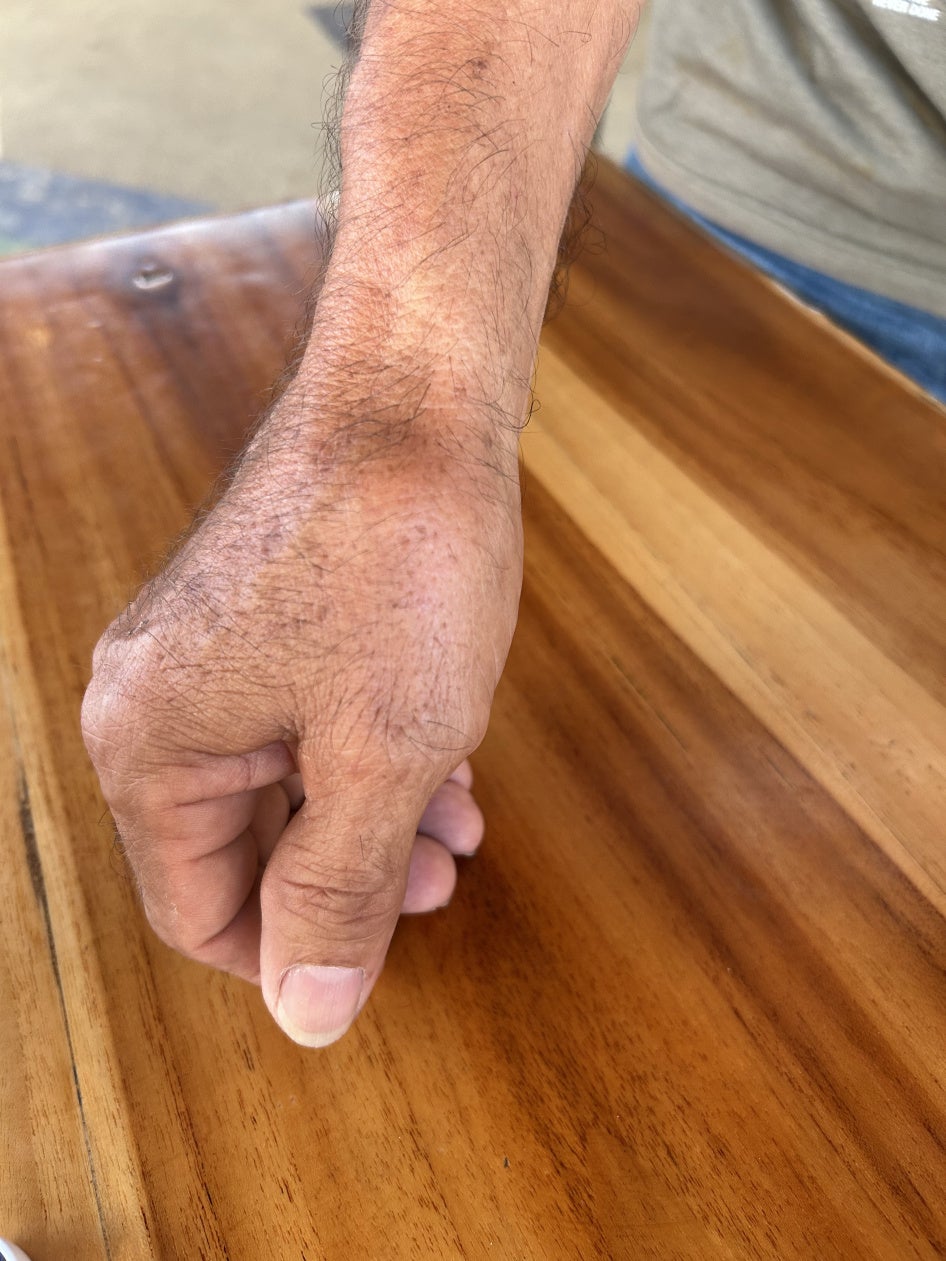 injured hand