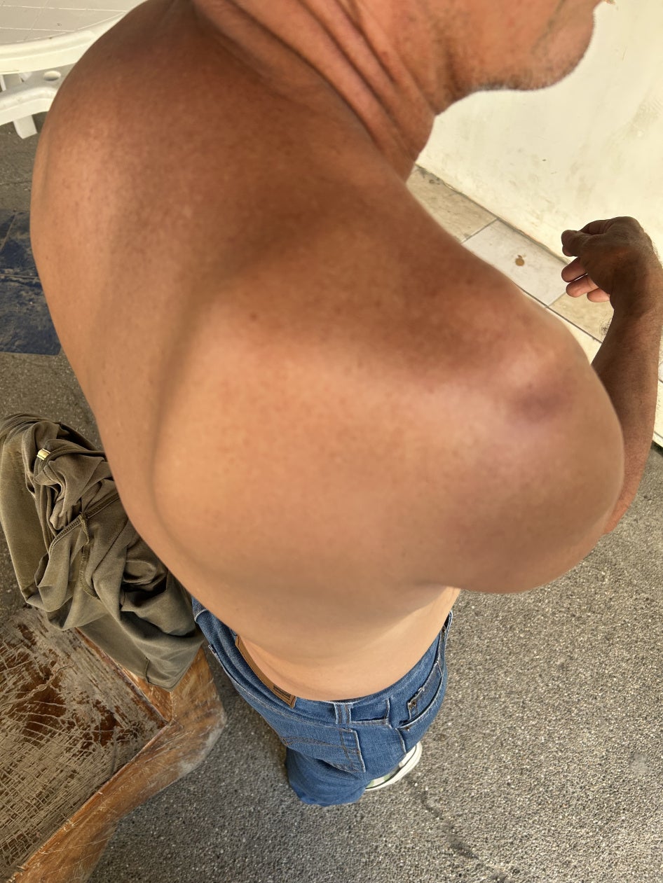 injuries to a shoulder