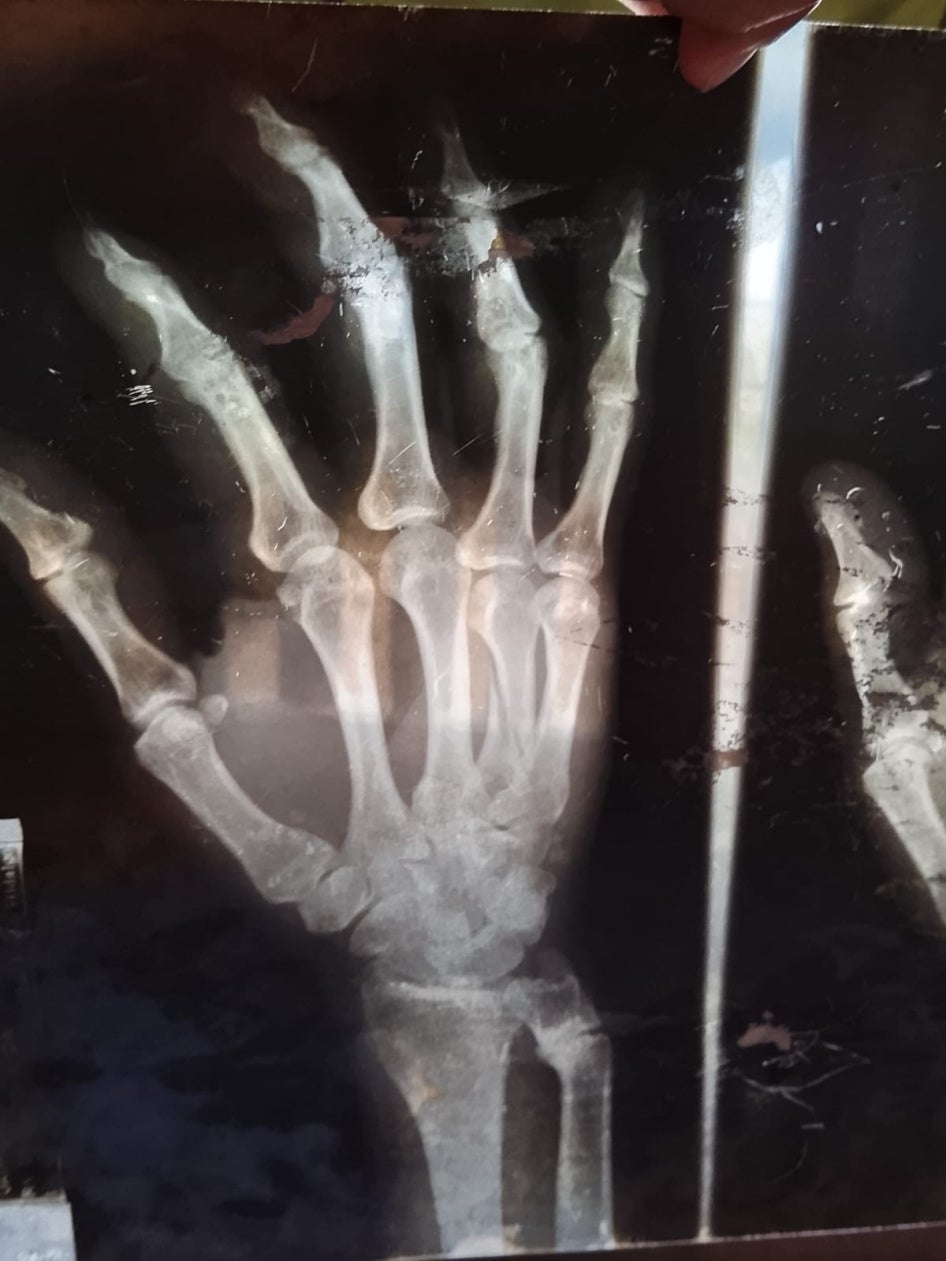 hand x-ray