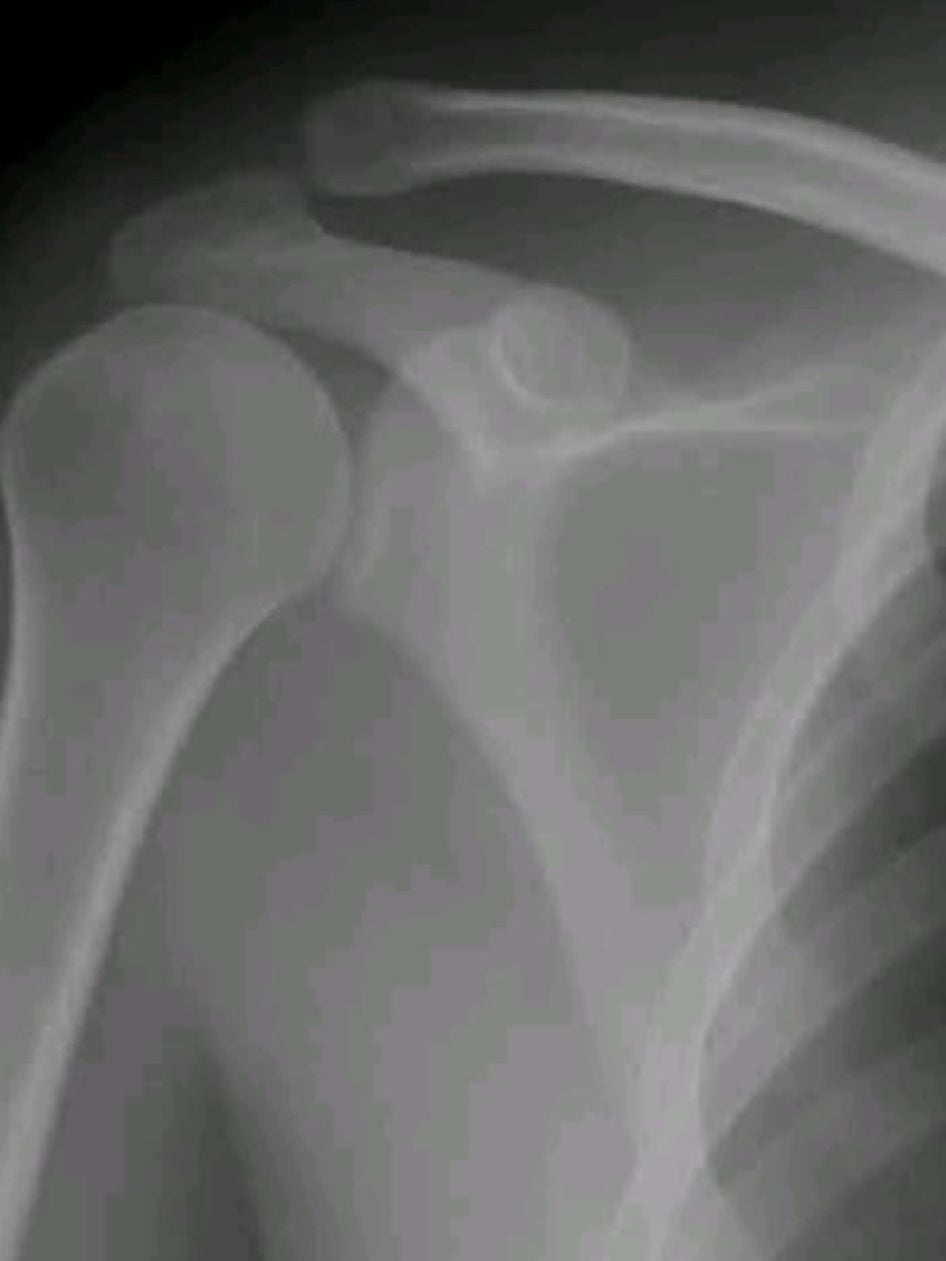 shoulder x-ray