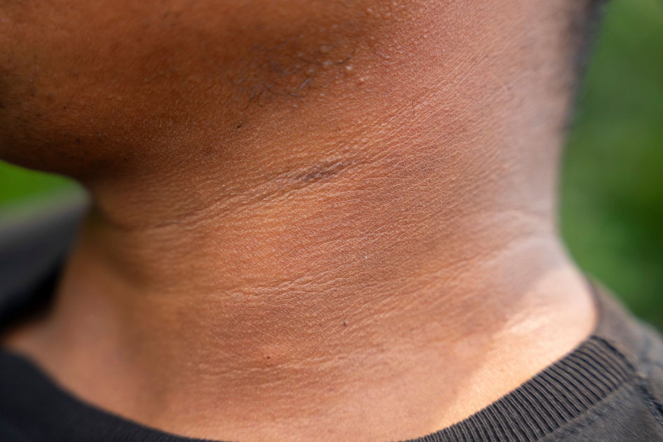 scars on a neck