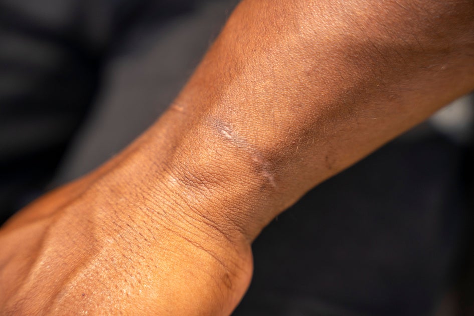 markings on a wrist 