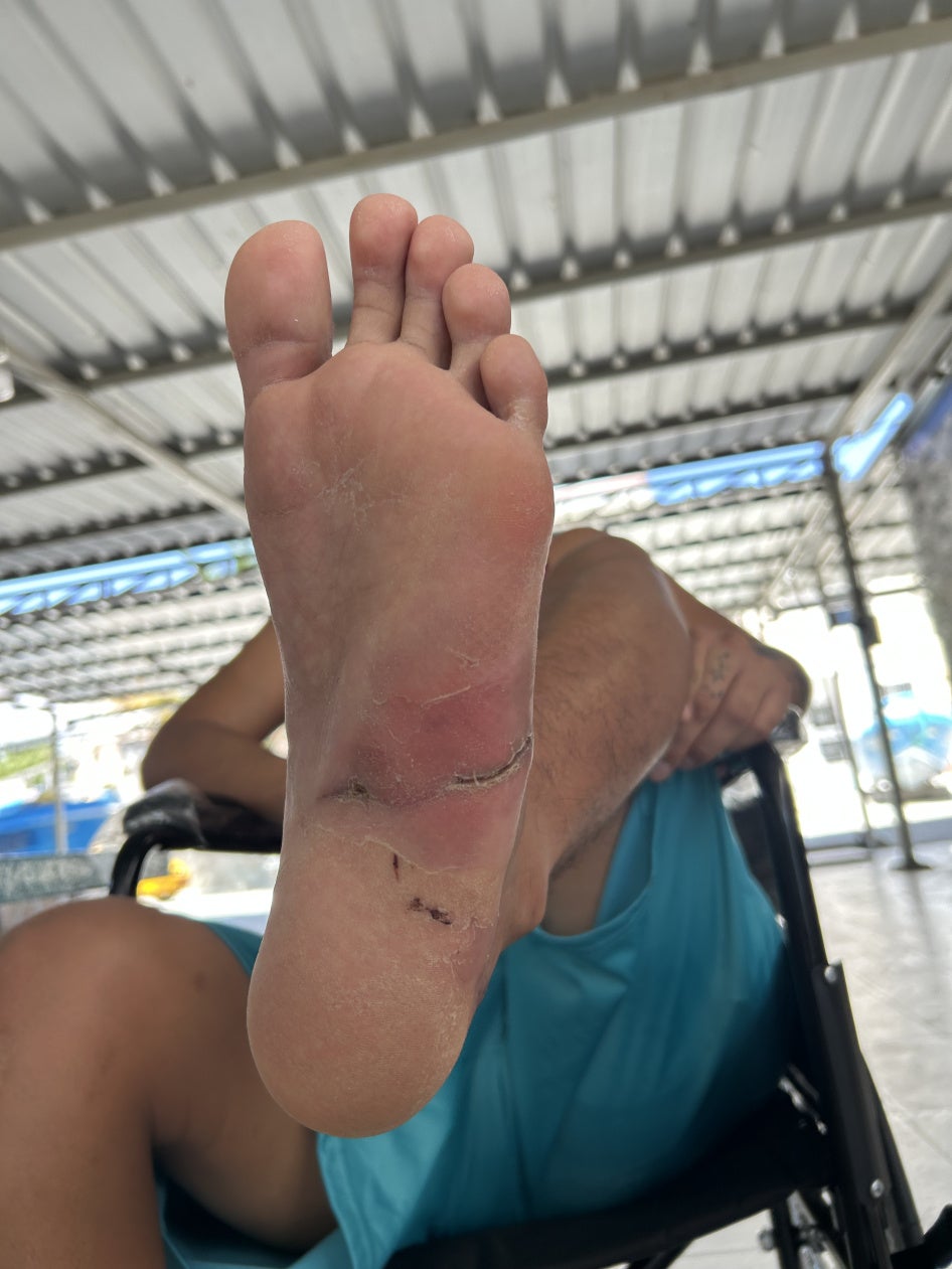 photo of an injuries to a foot