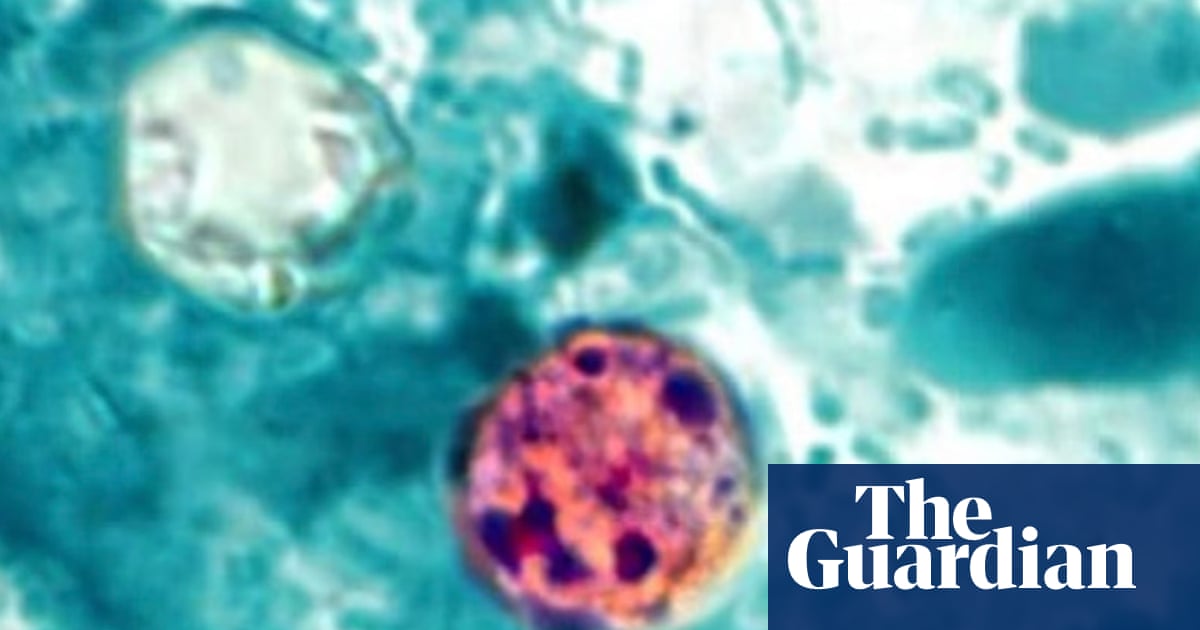 What is cyclosporiasis, the parasitic illness causing ‘explosive’ diarrhea? | US news
