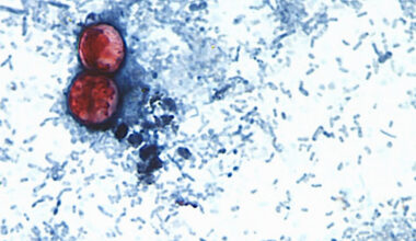What the Cyclospora Outbreak Reveals