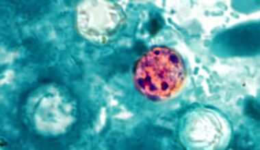 What is cyclosporiasis? Symptoms, total cases, map and latest as parasite outbreaks reach 31 states