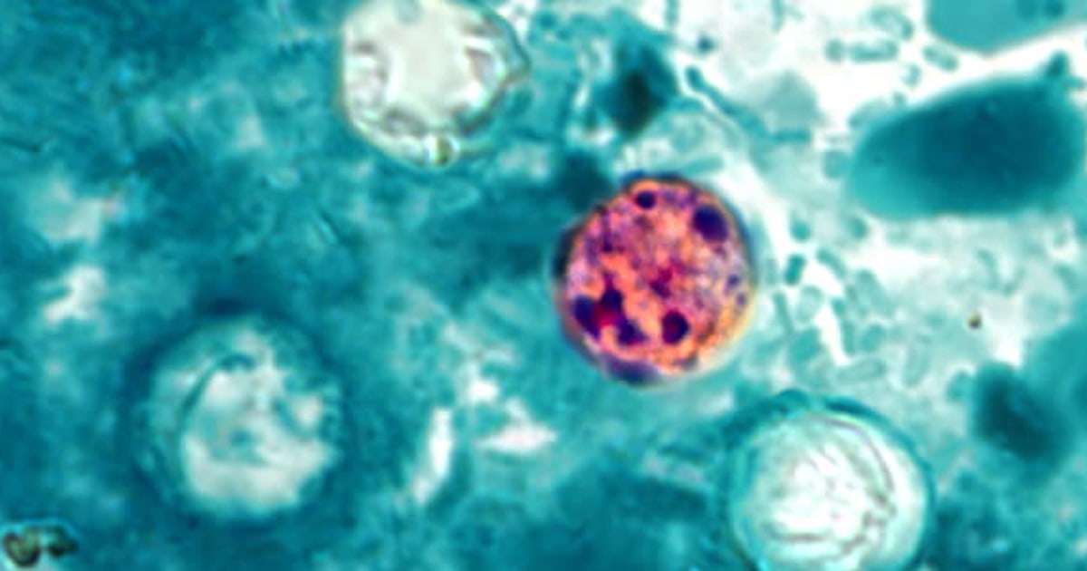 What is cyclosporiasis? Symptoms, total cases, map and latest as parasite outbreaks reach 31 states