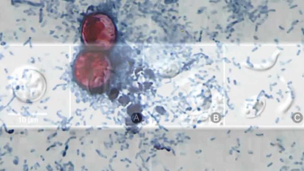 Cyclospora in Iowa: Polk County cyclosporiasis cases now over 30