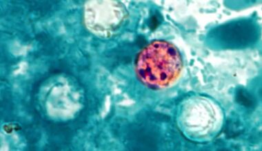 Oklahoma cyclosporiasis cases hit 172, OSDH says