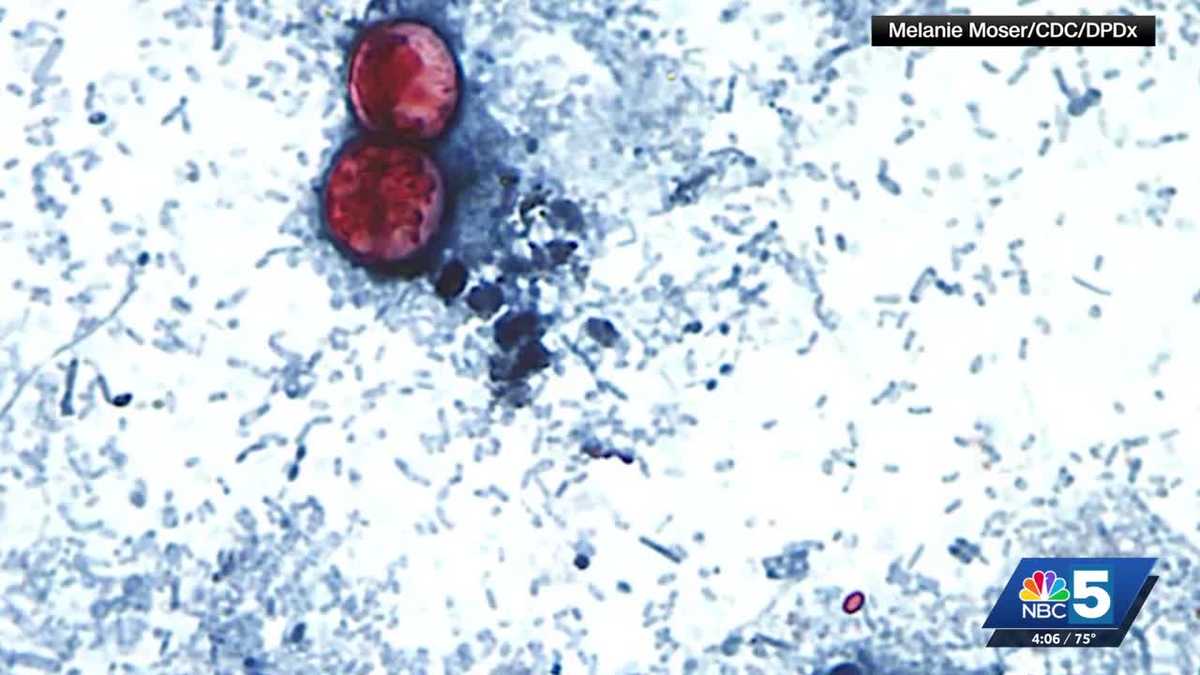 Vermont health officials confirm five cyclosporiasis cases, say none linked to recalled lettuce