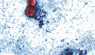 Northern Nevada Public Health reports first cyclosporiasis case in Washoe County | Local News