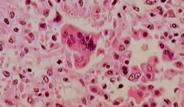 Delaware's 4 new cases of measles meet criteria of "outbreak" | The Latest from WDEL News