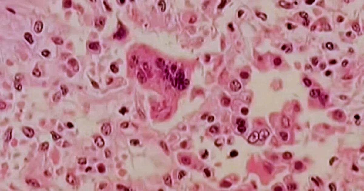 Delaware's 4 new cases of measles meet criteria of "outbreak" | The Latest from WDEL News