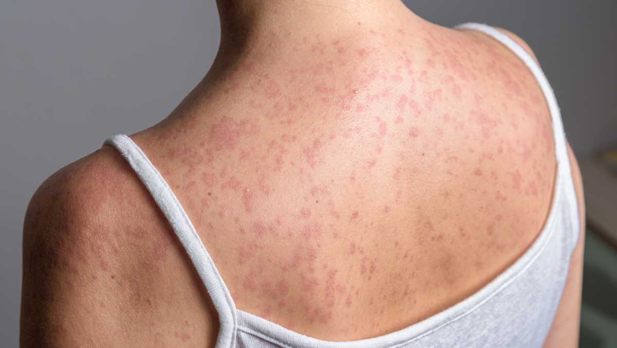 Measles in Iowa: First case of 2026 confirmed