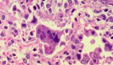 Measles exposure testing underway in Polk County