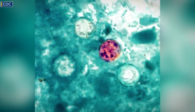 More people are seeking Cyclospora tests. Here's what patients should know :: WRAL.com