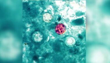 Precautions to take as cyclosporiasis cases in Michigan exceed 1,500