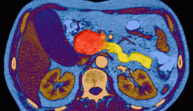 Pancreatic cancer experts gather to discuss what comes after daraxonrasib