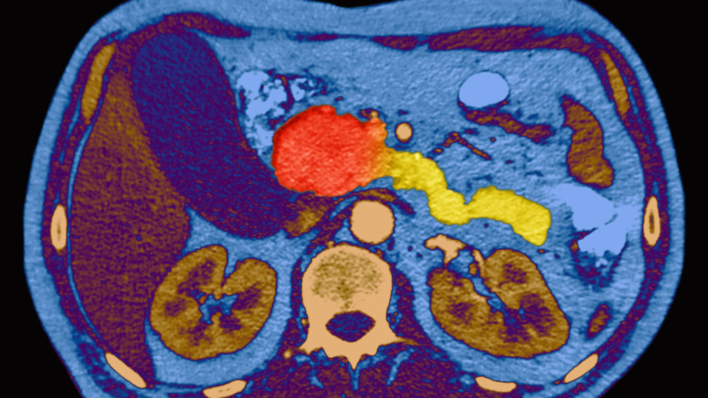 Pancreatic cancer experts gather to discuss what comes after daraxonrasib