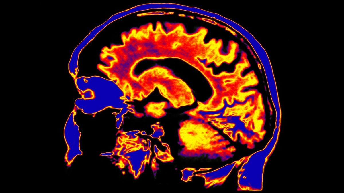 In a First, Chronic Fatigue Syndrome Linked to The Brain's Clearing System : ScienceAlert