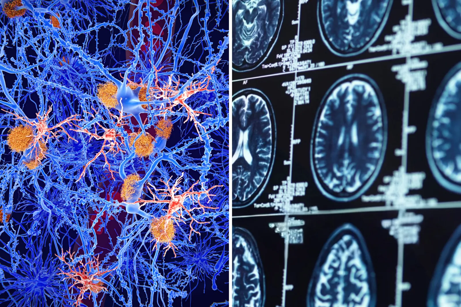 From left: Microglia cells in the brain; and scans of a brain on a computer screen.